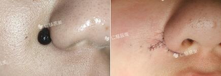 鼻翼色素痣