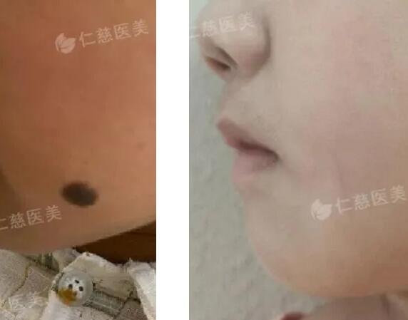 色素痣