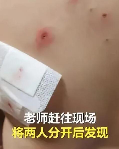 外源性文身