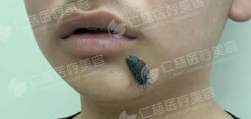 <a href='http://www.xzrcym.com/' target='_blank'><u>仁慈医美</u></a>