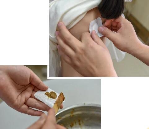 三伏贴