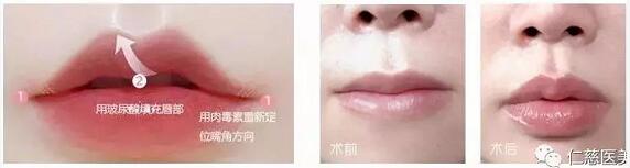 进口玻尿酸全脸填充